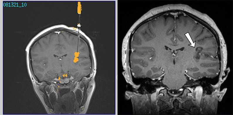Epilepsy LITT Example Before and After